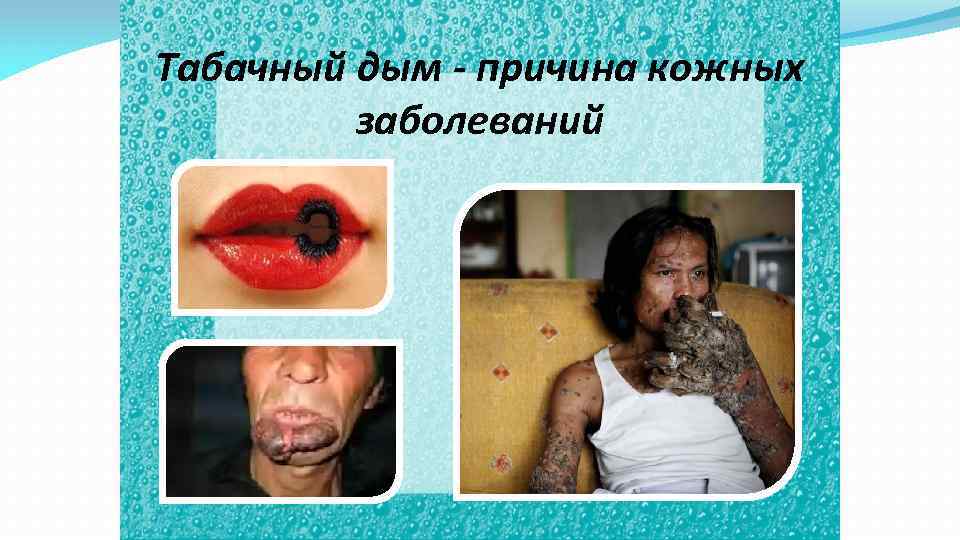 Табачный дым - причина кожных заболеваний 