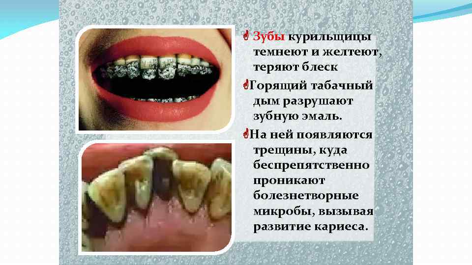  Зубы курильщицы темнеют и желтеют, теряют блеск Горящий табачный дым разрушают зубную эмаль.
