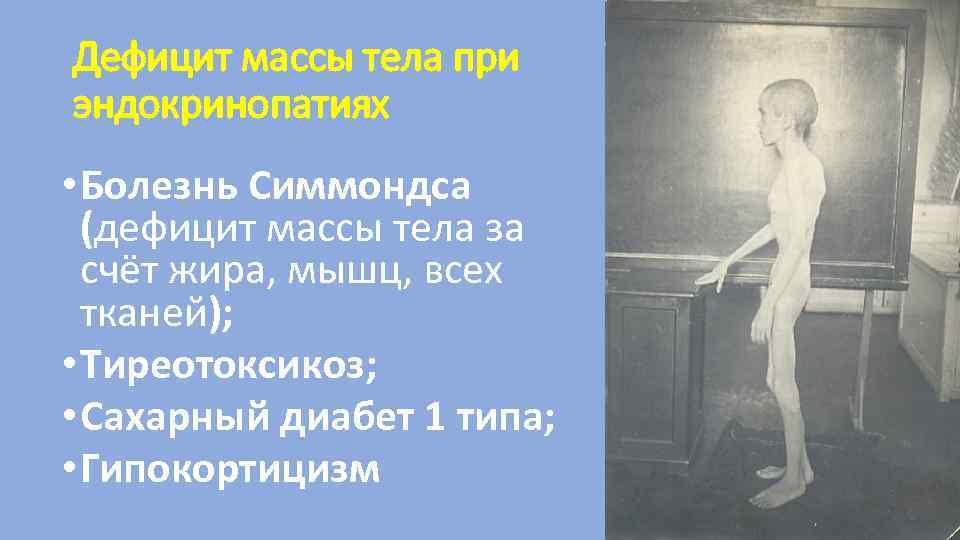Дефицит массы тела при эндокринопатиях • Болезнь Симмондса (дефицит массы тела за счёт жира,