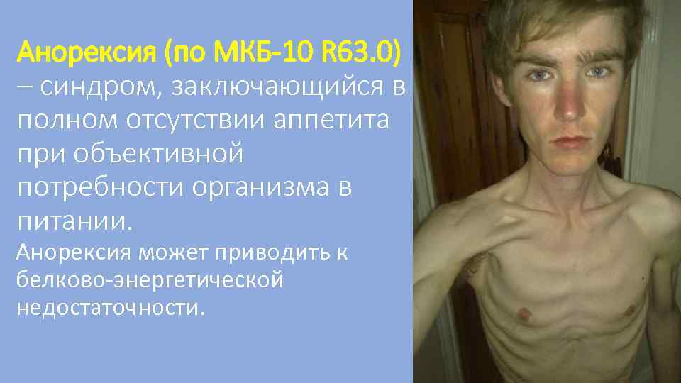 Анорексия (по МКБ-10 R 63. 0) – синдром, заключающийся в полном отсутствии аппетита при