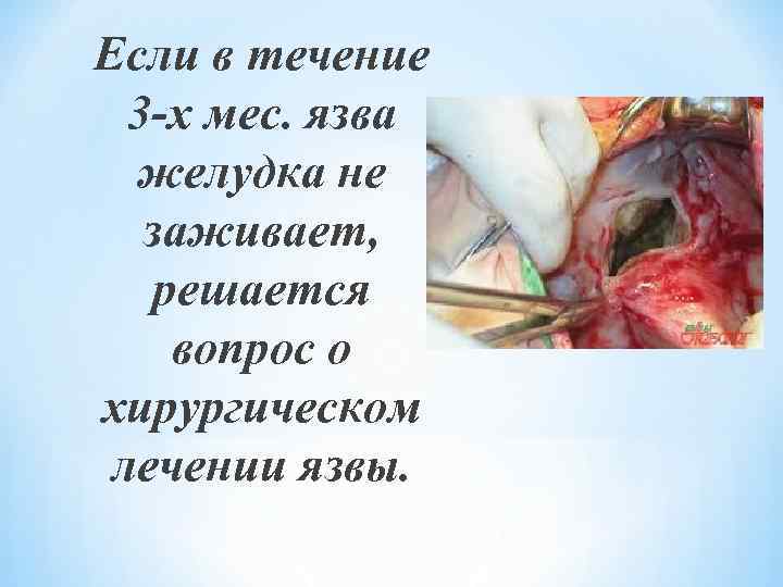 Если в течение 3 -х мес. язва желудка не заживает, решается вопрос о хирургическом