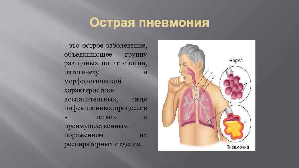 Острая пневмония - это острое заболевание, объединяющее группу различных по этиологии, патогенезу и морфологической