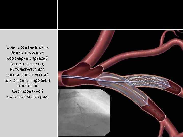 Стентирование сосудов сердца