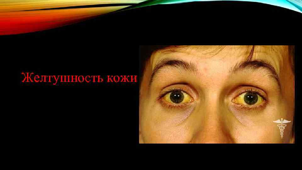 Желтушность кожи 