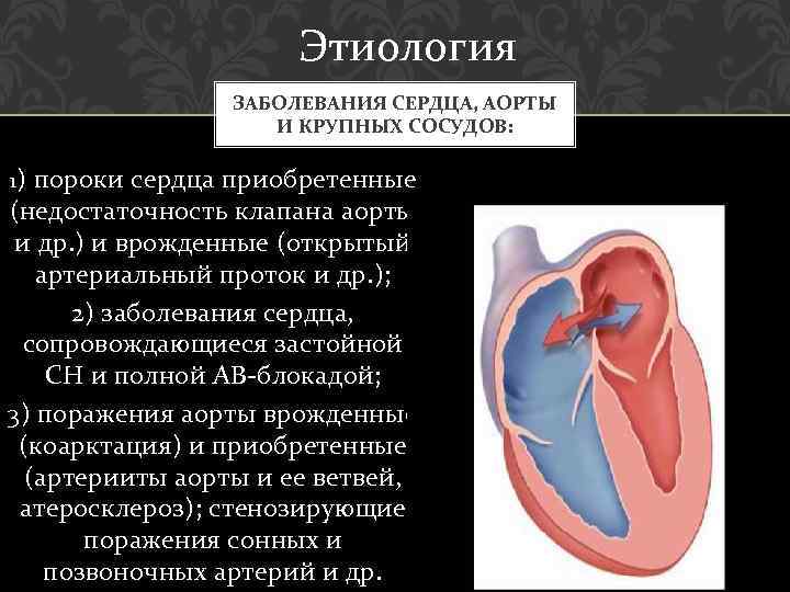 Этиология ЗАБОЛЕВАНИЯ СЕРДЦА, АОРТЫ И КРУПНЫХ СОСУДОВ: 1) пороки сердца приобретенные (недостаточность клапана аорты
