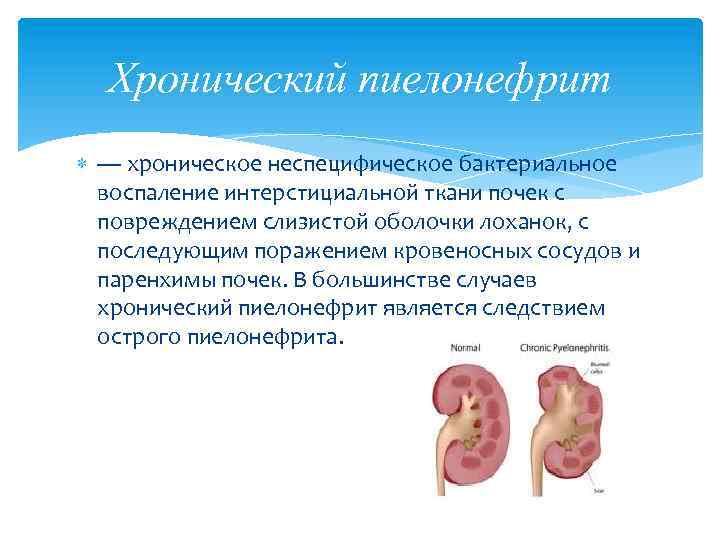 Хронический пиелонефрит — хроническое неспецифическое бактериальное воспаление интерстициальной ткани почек с повреждением слизистой оболочки