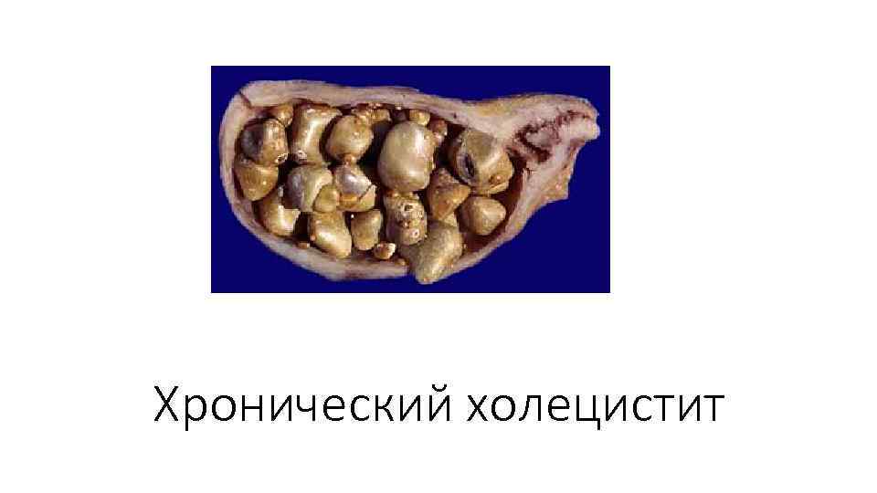 Хронический холецистит 