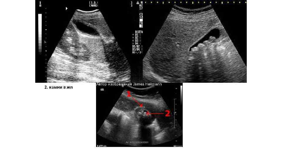 1. утолщение стенки жп 2. камни в жп 