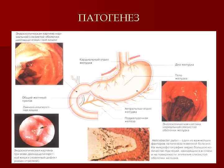 ПАТОГЕНЕЗ 7 