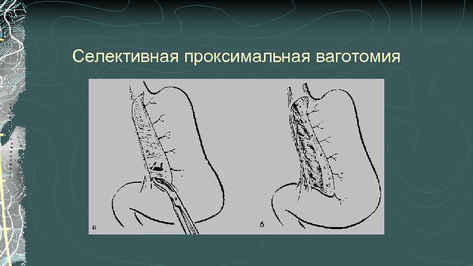 Селективная проксимальная ваготомия 