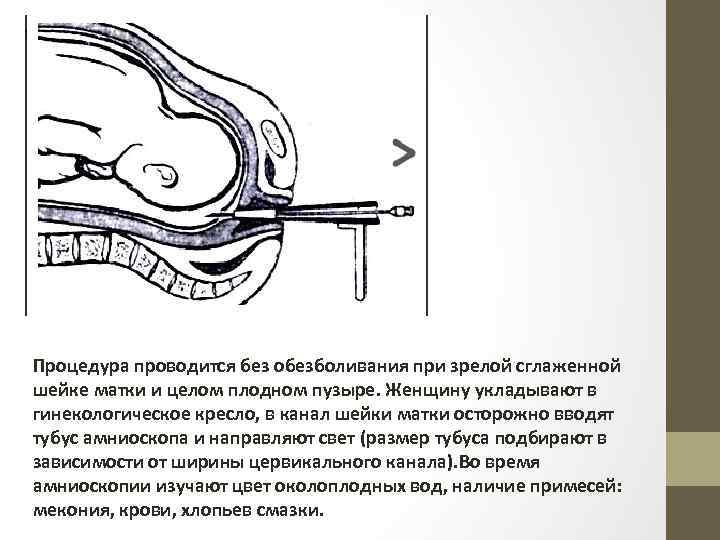 Сглаживание шейки матки. Плодный пузырь в цервикальном канале. Введение ламинарий в шейку матки. Обезболивание шейки матки местное.