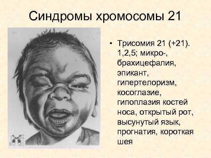 Синдромы хромосомы 21 • Трисомия 21 (+21). 1, 2, 5; микро-, брахицефалия, эпикант, гипертелоризм,