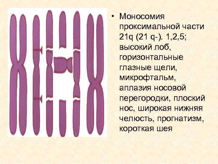  • Моносомия проксимальной части 21 q (21 q-). 1, 2, 5; высокий лоб,