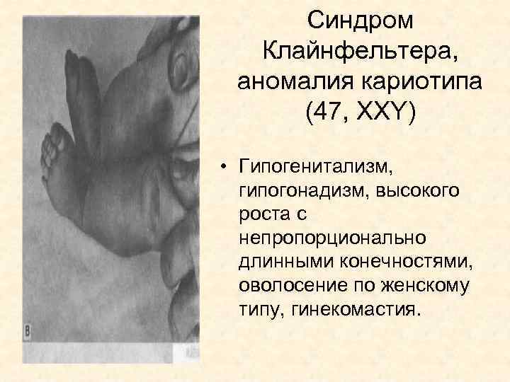 Синдром Клайнфельтера, аномалия кариотипа (47, XXY) • Гипогенитализм, гипогонадизм, высокого роста с непропорционально длинными