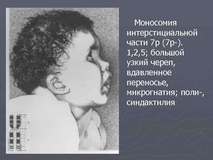 Моносомия интерстициальной части 7 р (7 р ). 1, 2, 5; большой узкий череп,