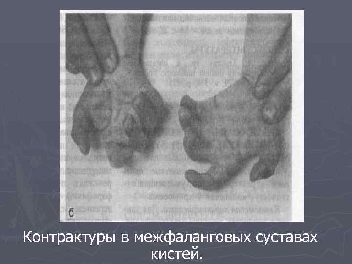 Контрактуры в межфаланговых суставах кистей. 