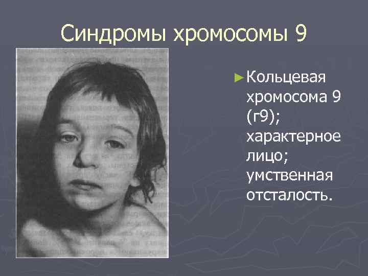 Синдромы хромосомы 9 ► Кольцевая хромосома 9 (г 9); характерное лицо; умственная отсталость. 