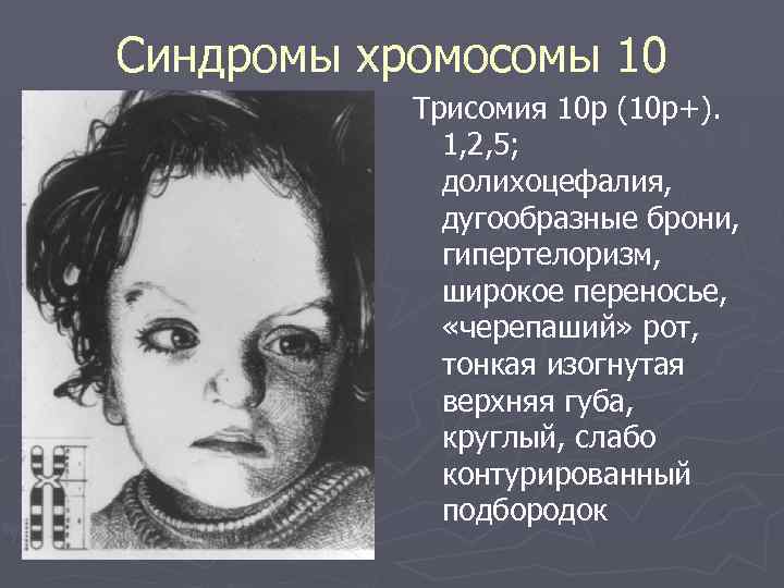 Синдромы хромосомы 10 Трисомия 10 p (10 р+). 1, 2, 5; долихоцефалия, дугообразные брони,