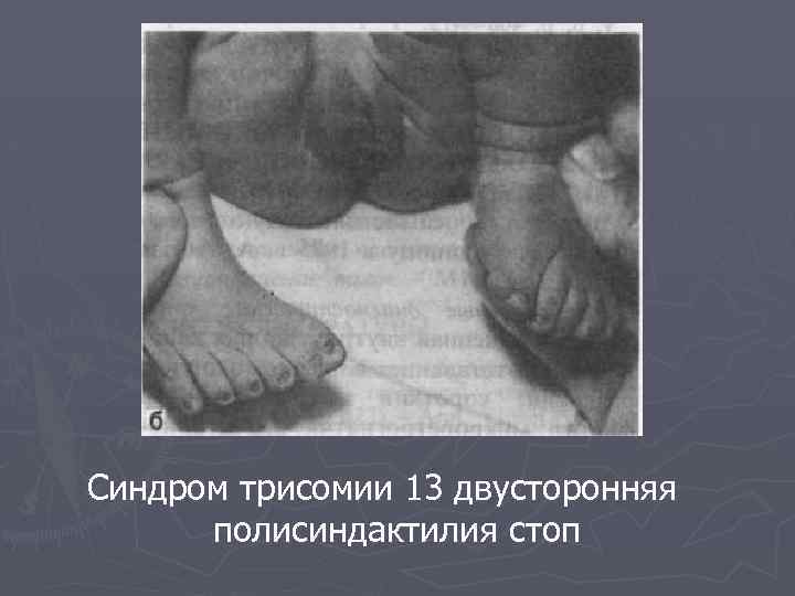 Синдром трисомии 13 двусторонняя полисиндактилия стоп 