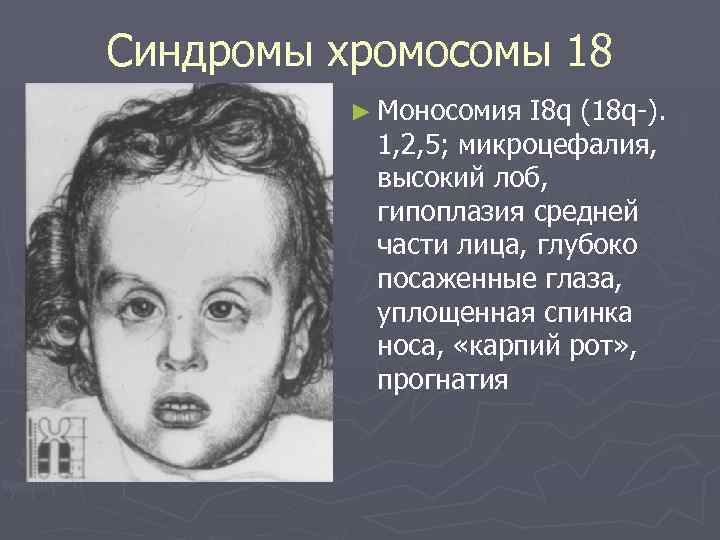 Синдромы хромосомы 18 ► Моносомия I 8 q (18 q ). 1, 2, 5;