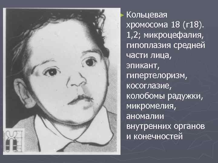 ► Кольцевая хромосома 18 (г 18). 1, 2; микроцефалия, гипоплазия средней части лица, эпикант,