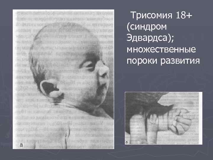 Трисомия 18+ (синдром Эдвардса); множественные пороки развития 