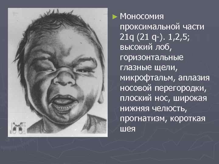 ► Моносомия проксимальной части 21 q (21 q ). 1, 2, 5; высокий лоб,