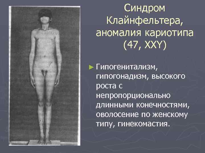 Синдром Клайнфельтера, аномалия кариотипа (47, XXY) ► Гипогенитализм, гипогонадизм, высокого роста с непропорционально длинными