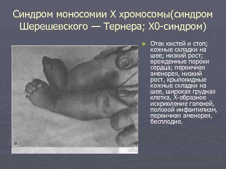 Синдром моносомии Х хромосомы(синдром Шерешевского — Тернера; Х 0 синдром) ► Отек кистей и
