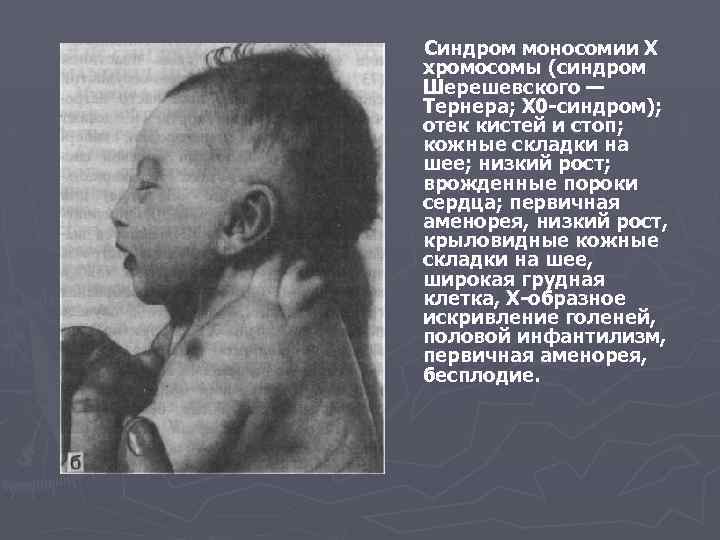  Синдром моносомии Х хромосомы (синдром Шерешевского — Тернера; Х 0 -синдром); отек кистей