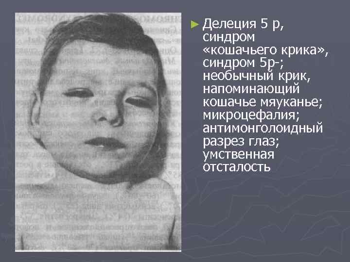 ► Делеция 5 р, синдром «кошачьего крика» , синдром 5 p ; необычный крик,