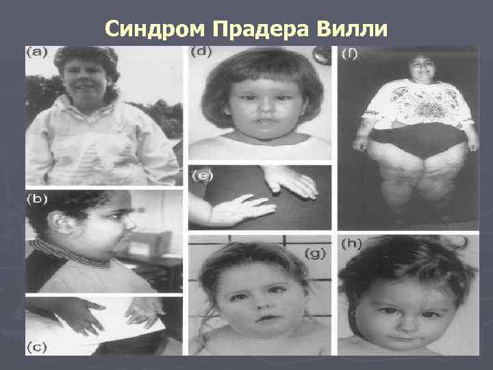 Синдром Прадера Вилли 