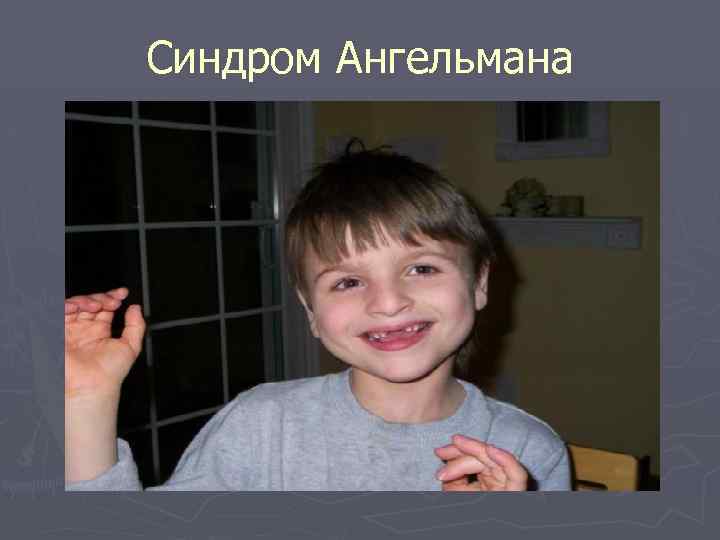 Синдром Ангельмана 