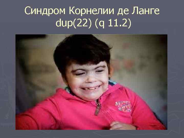 Синдром Корнелии де Ланге dup(22) (q 11. 2) 