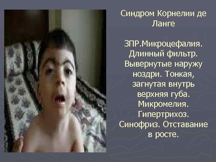 Синдром Корнелии де Ланге ЗПР. Микроцефалия. Длинный фильтр. Вывернутые наружу ноздри. Тонкая, загнутая внутрь