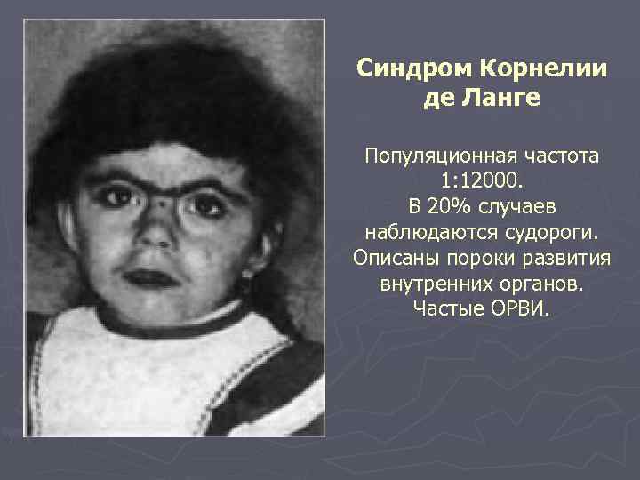 Синдром Корнелии де Ланге Популяционная частота 1: 12000. В 20% случаев наблюдаются судороги. Описаны