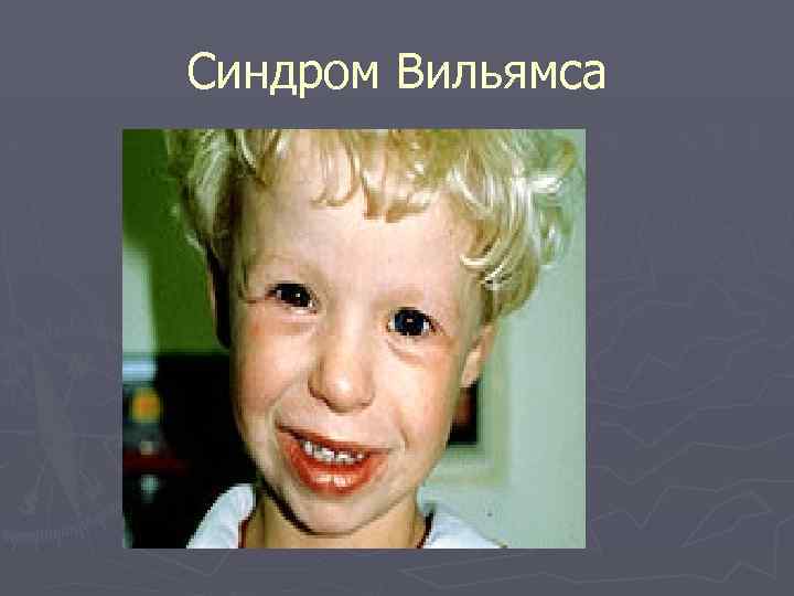 Синдром Вильямса 