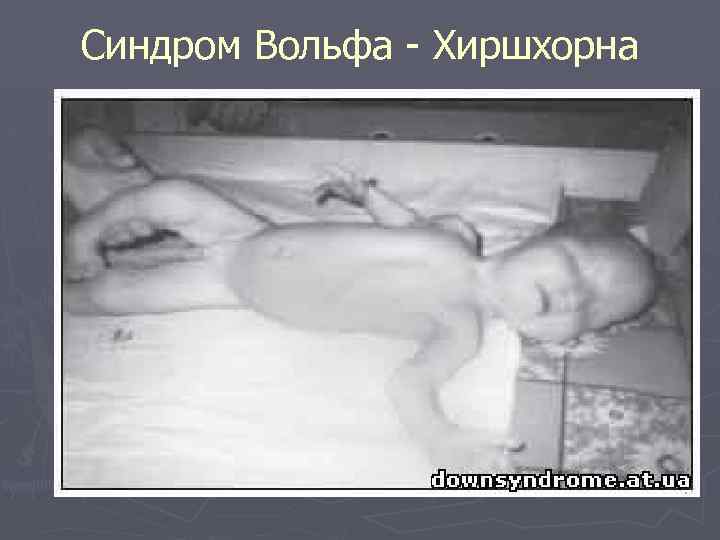 Синдром Вольфа Хиршхорна 