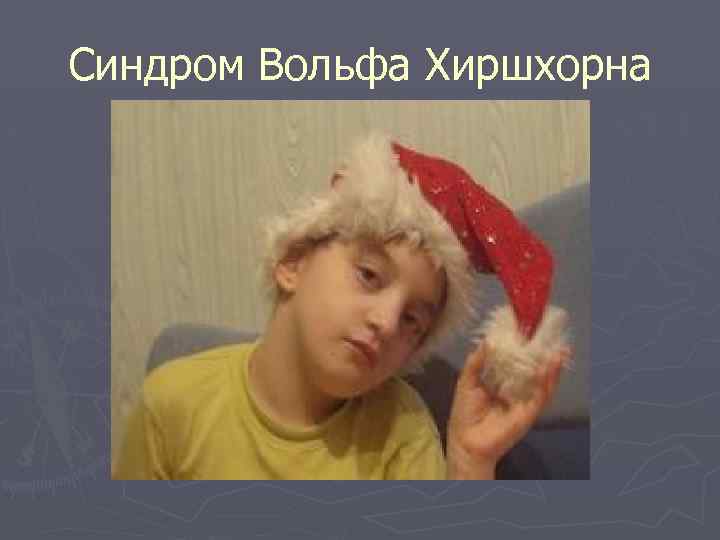 Синдром Вольфа Хиршхорна 