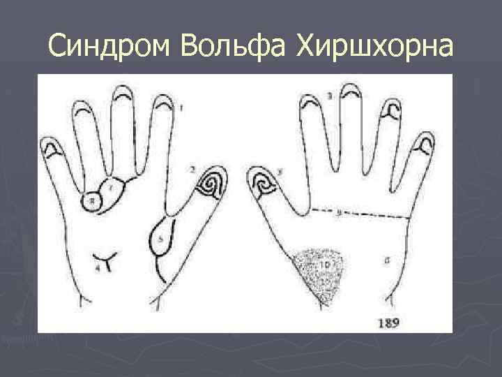 Синдром Вольфа Хиршхорна 