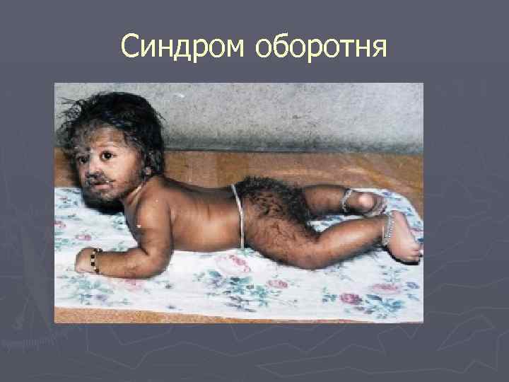 Синдром оборотня 