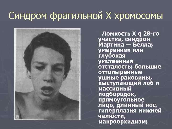 Синдром фрагильной Х хромосомы Ломкость X q 28 -го участка, синдром Мартина — Белла;