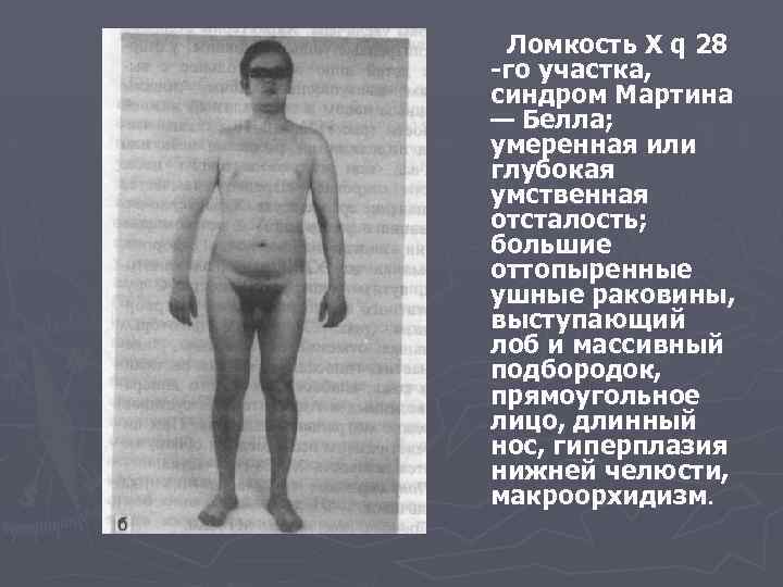  Ломкость X q 28 -го участка, синдром Мартина — Белла; умеренная или глубокая