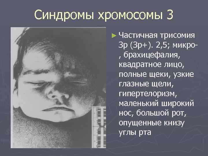 Синдромы хромосомы 3 ► Частичная трисомия Зр (Зр+). 2, 5; микро , брахицефалия, квадратное
