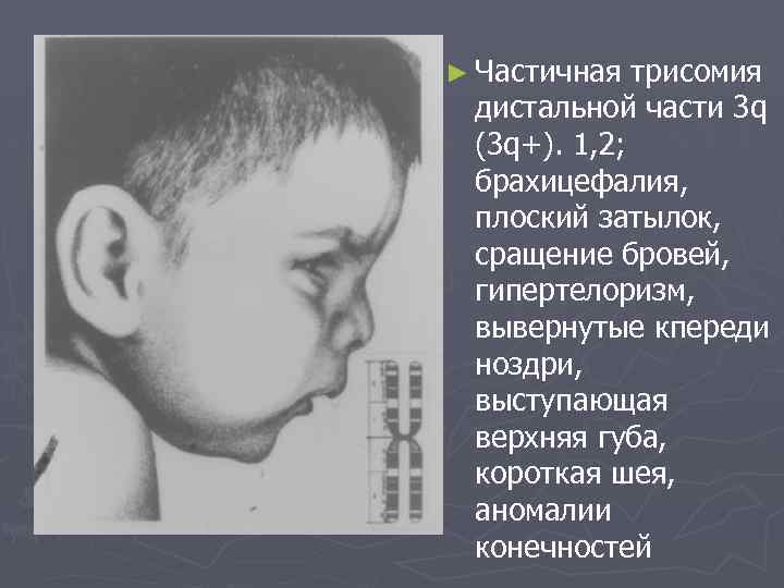 ► Частичная трисомия дистальной части 3 q (3 q+). 1, 2; брахицефалия, плоский затылок,