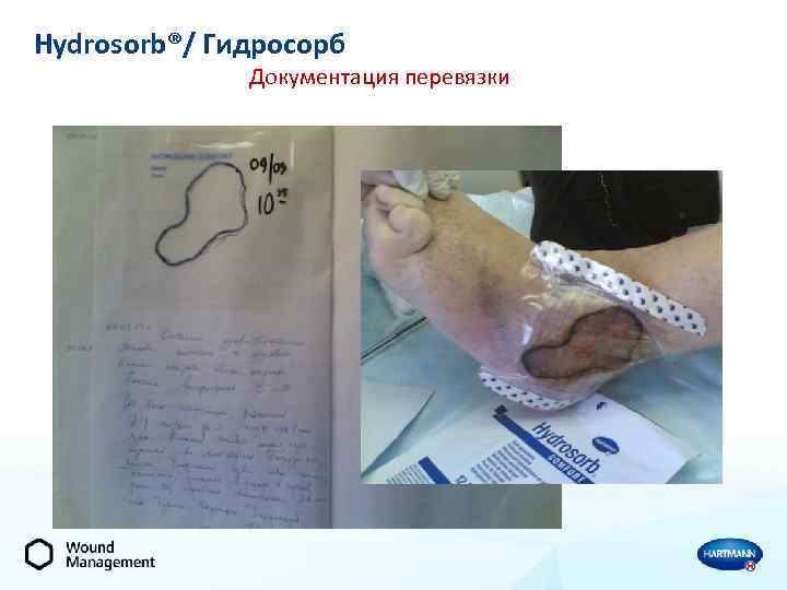 Hydrosorb®/ Гидросорб Документация перевязки 