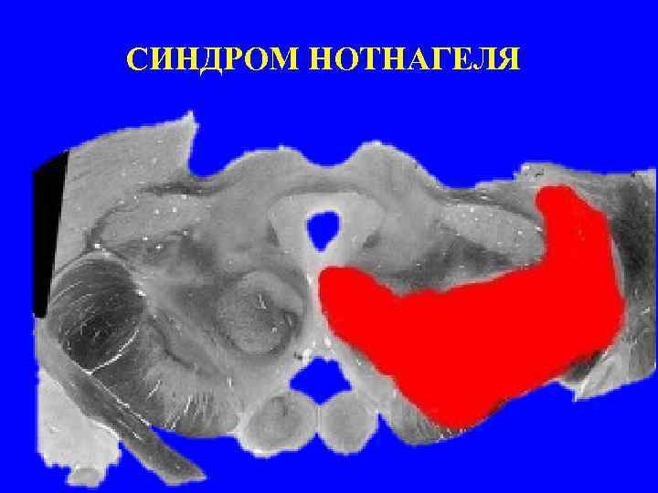 СИНДРОМ НОТНАГЕЛЯ 