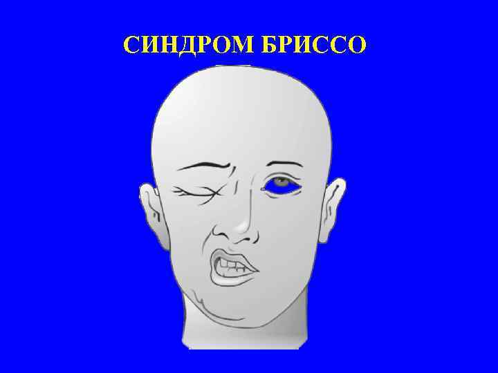 СИНДРОМ БРИССО 