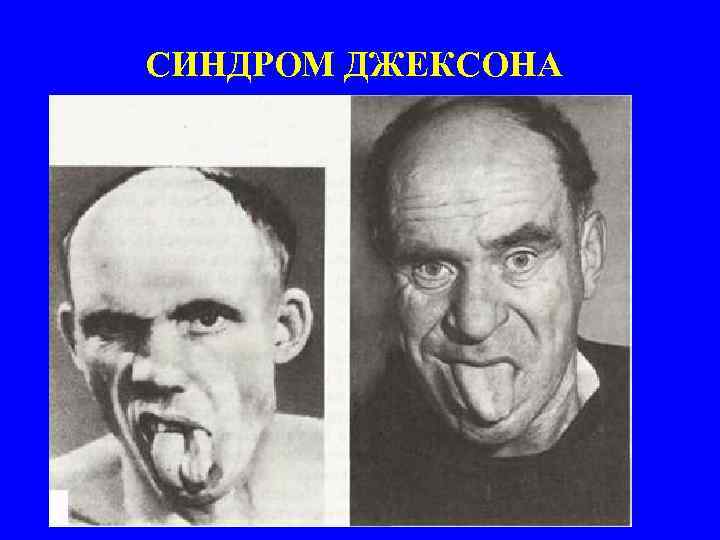 СИНДРОМ ДЖЕКСОНА 