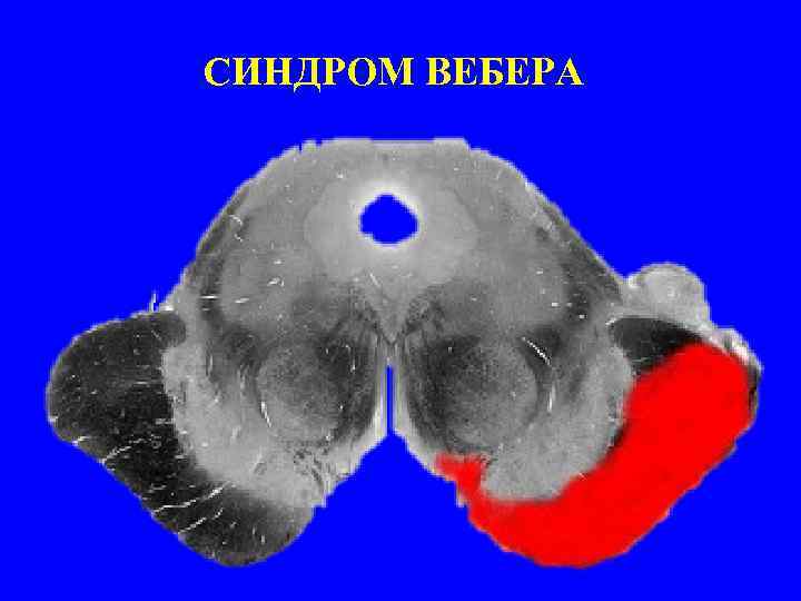 СИНДРОМ ВЕБЕРА 